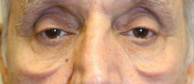 Blepharoplasty before photo