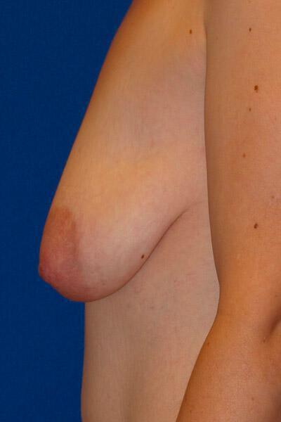 Breast Augmentation before photo