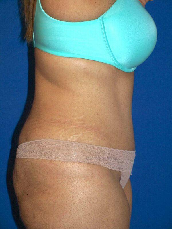 Tummy Tuck result at ARC Plastic Surgery