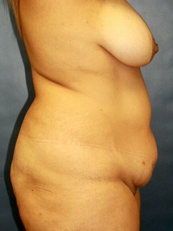 Tummy Tuck before photo
