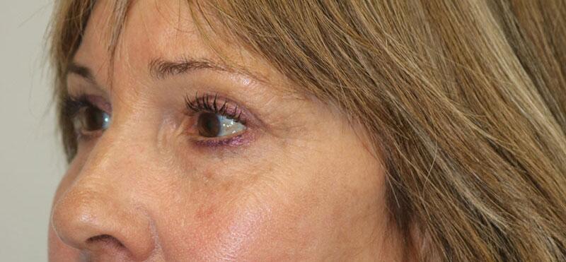 Blepharoplasty result at ARC Plastic Surgery