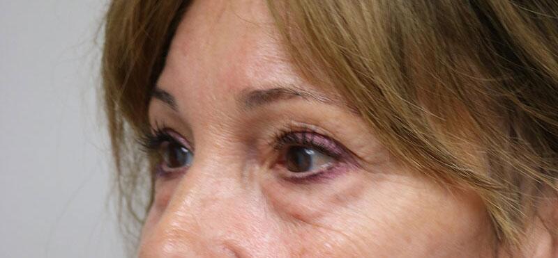 Blepharoplasty before photo