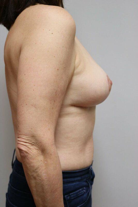 Breast Reduction result at ARC Plastic Surgery