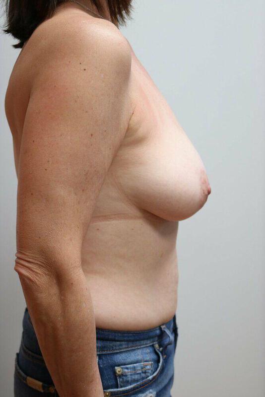 Breast Reduction before photo