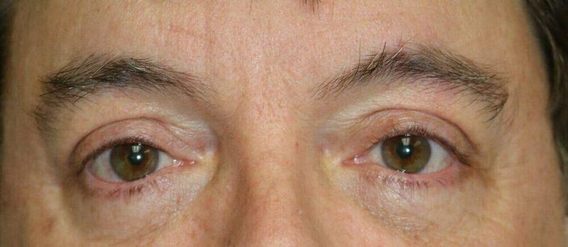 Blepharoplasty result at ARC Plastic Surgery