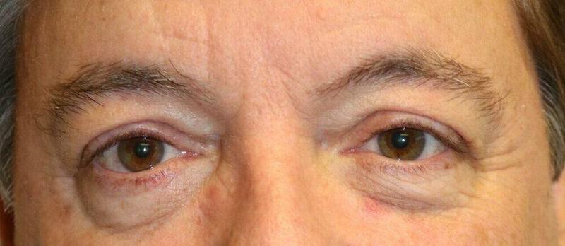 Blepharoplasty before photo
