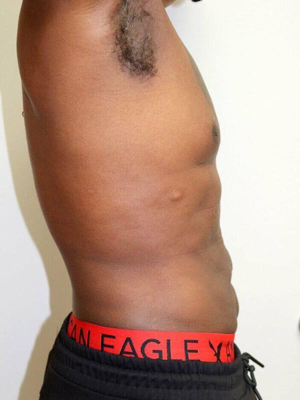 Liposuction result at ARC Plastic Surgery