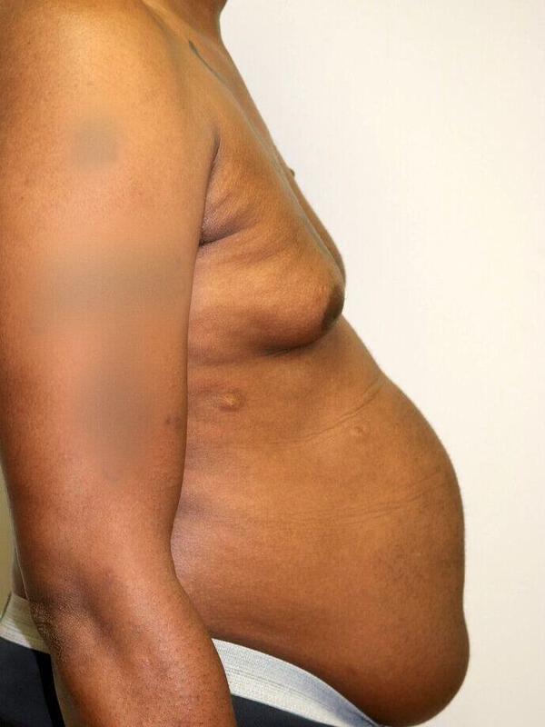 Liposuction before photo