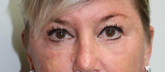 Blepharoplasty result at ARC Plastic Surgery