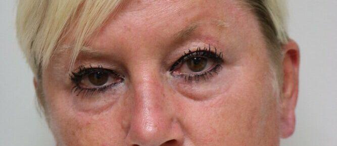 Blepharoplasty before photo