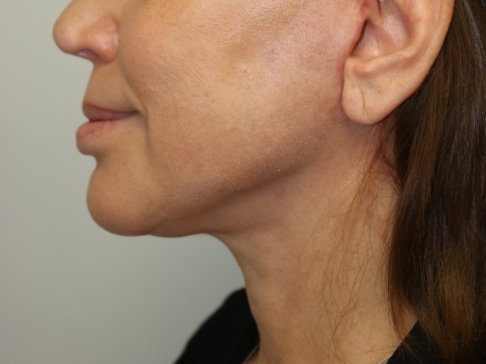 A result from ARC Plastic Surgery