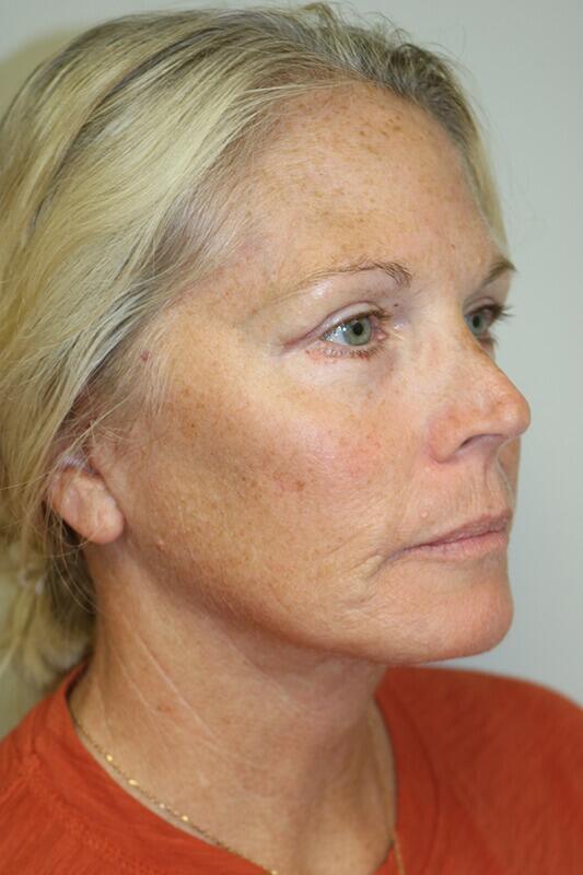Facelift result at ARC Plastic Surgery