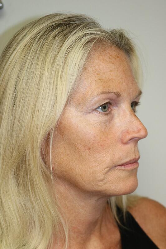Facelift before photo