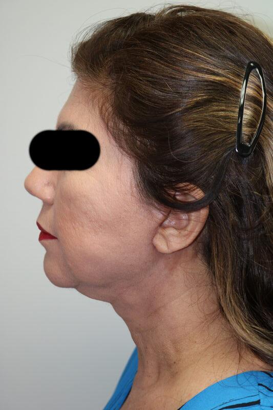 Facelift result at ARC Plastic Surgery