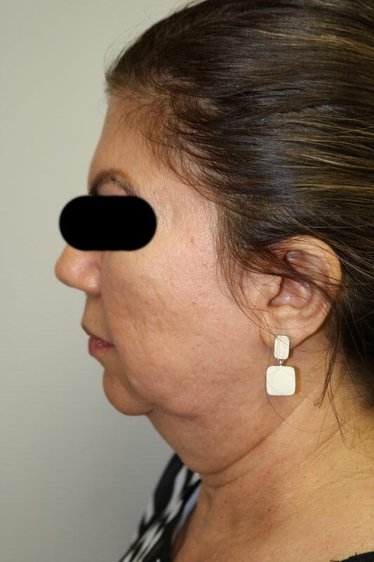 Facelift before photo