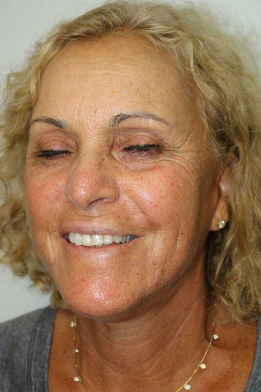 Facelift result at ARC Plastic Surgery