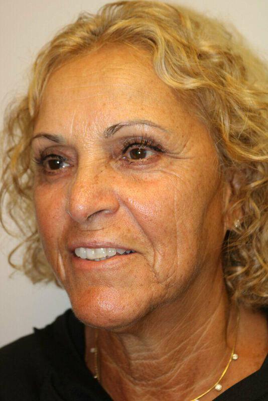 Facelift before photo