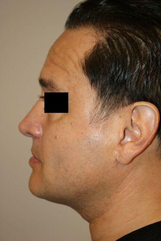 Rhinoplasty result at ARC Plastic Surgery