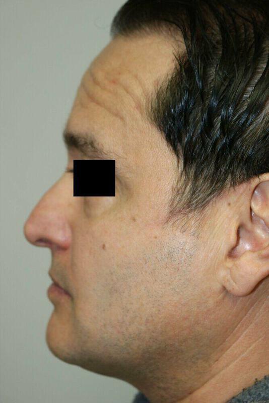 Rhinoplasty before photo