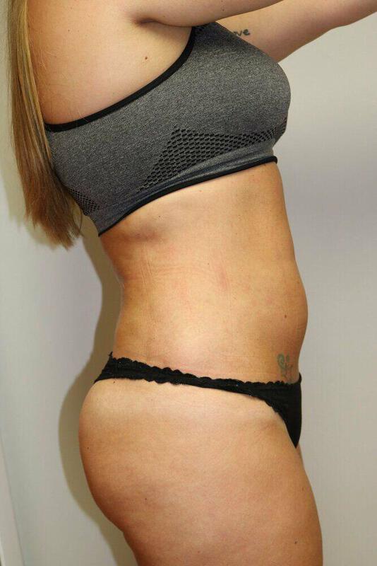 Liposuction result at ARC Plastic Surgery