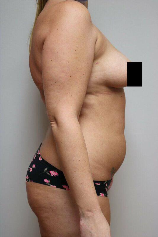 Liposuction before photo