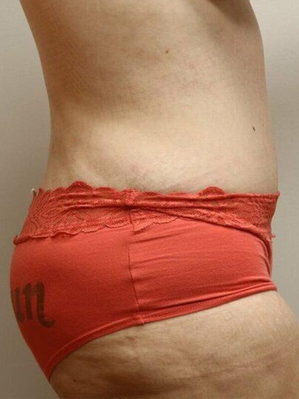 Tummy Tuck result at ARC Plastic Surgery