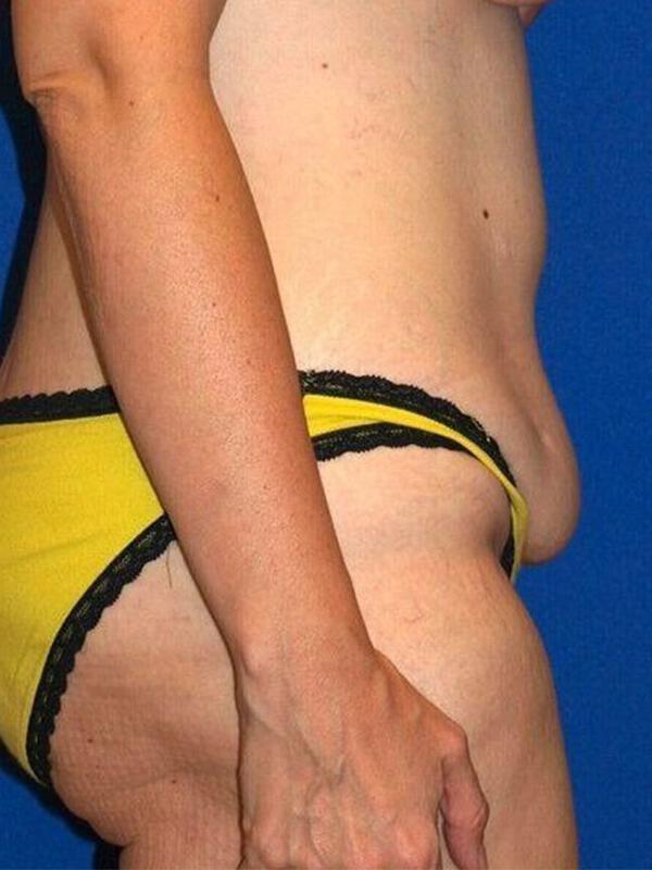 Tummy Tuck before photo