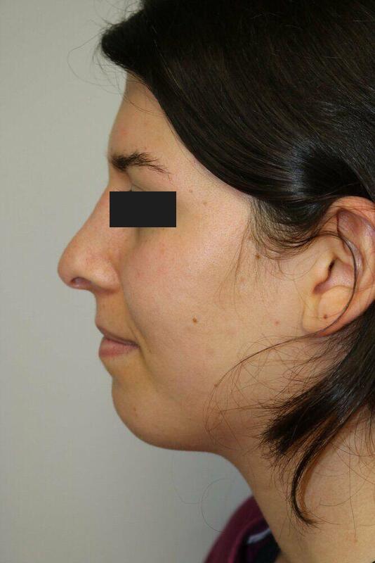 Rhinoplasty result at ARC Plastic Surgery
