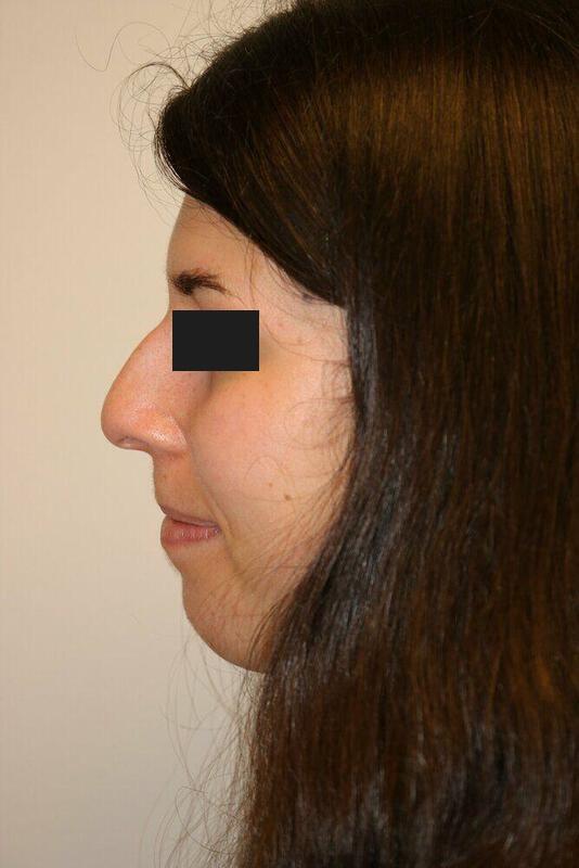 Rhinoplasty before photo