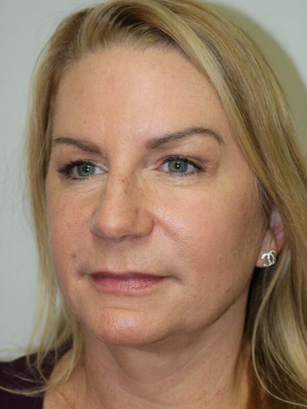 Facelift result at ARC Plastic Surgery
