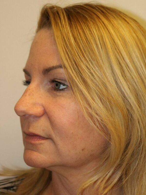 Facelift before photo