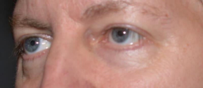 Blepharoplasty result at ARC Plastic Surgery