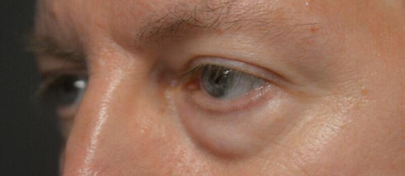 Blepharoplasty before photo