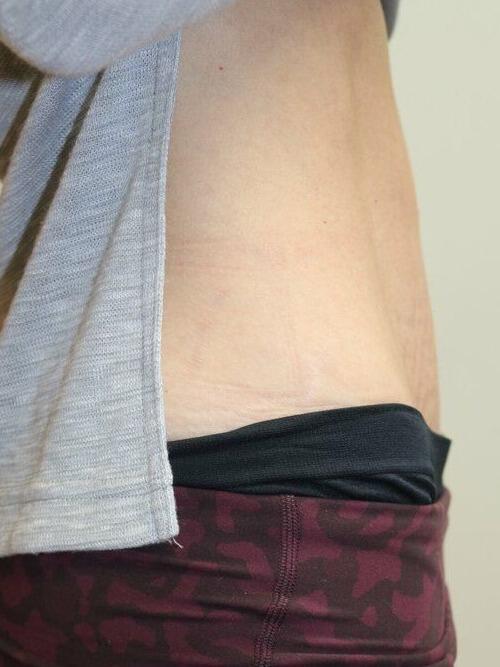 Tummy Tuck result at ARC Plastic Surgery