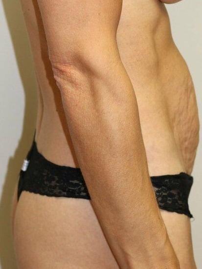 Tummy Tuck before photo