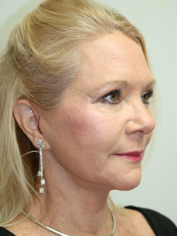 Facelift result at ARC Plastic Surgery