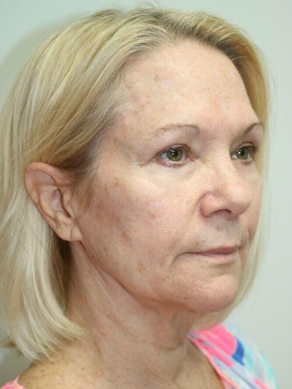 Facelift before photo