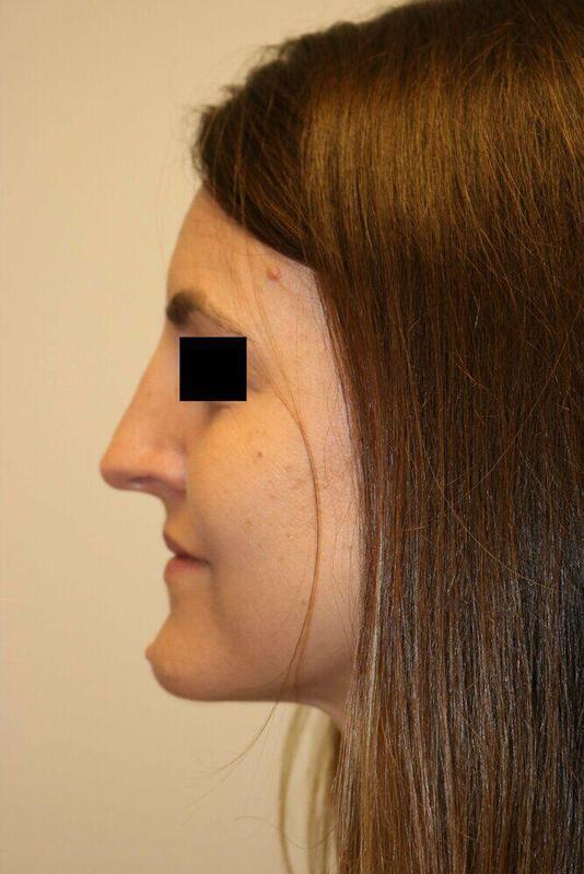 Rhinoplasty result at ARC Plastic Surgery
