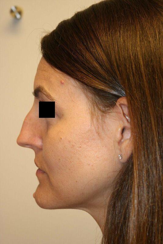 Rhinoplasty before photo