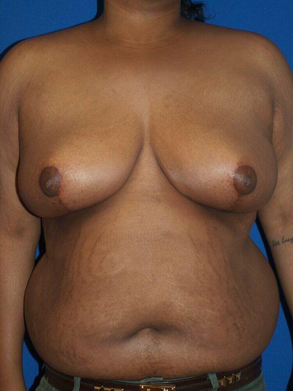 Breast Reduction result at ARC Plastic Surgery