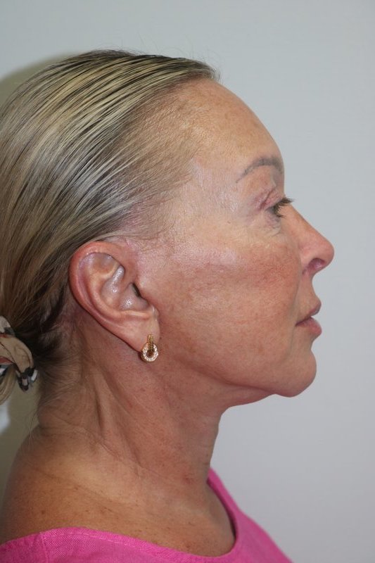 A result from ARC Plastic Surgery