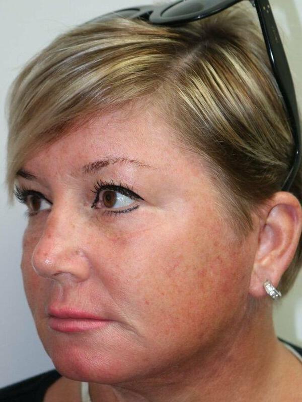 Facelift result at ARC Plastic Surgery