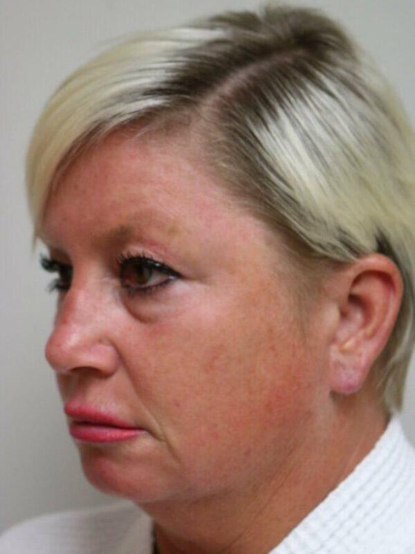 Facelift before photo