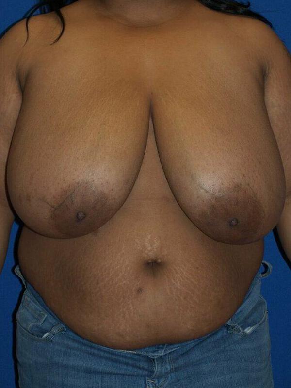 Breast Reduction before photo