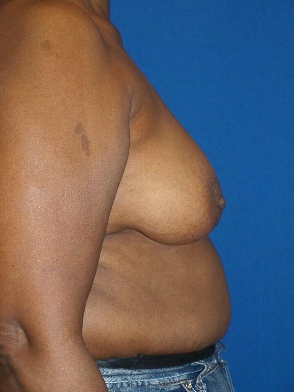 Breast Lift before photo