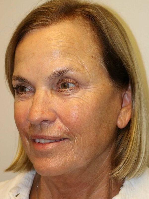 Facelift result at ARC Plastic Surgery