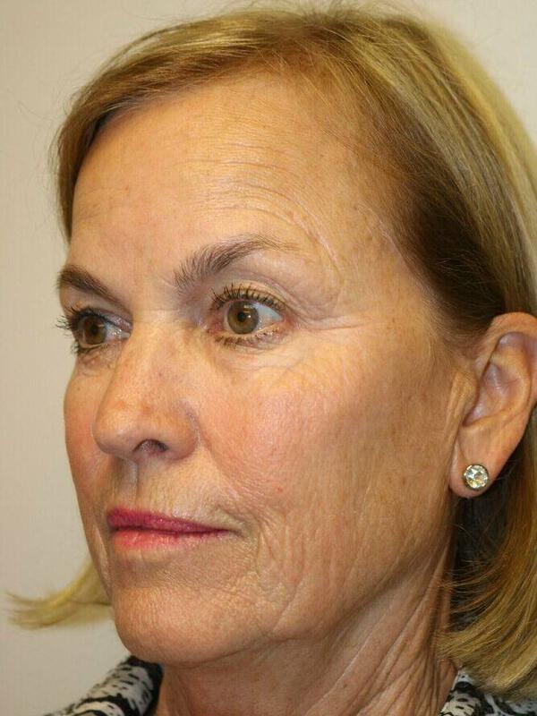 Facelift before photo
