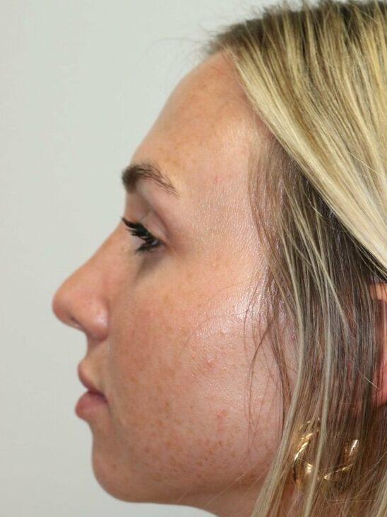 Rhinoplasty result at ARC Plastic Surgery