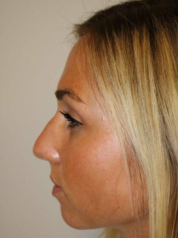 Rhinoplasty before photo
