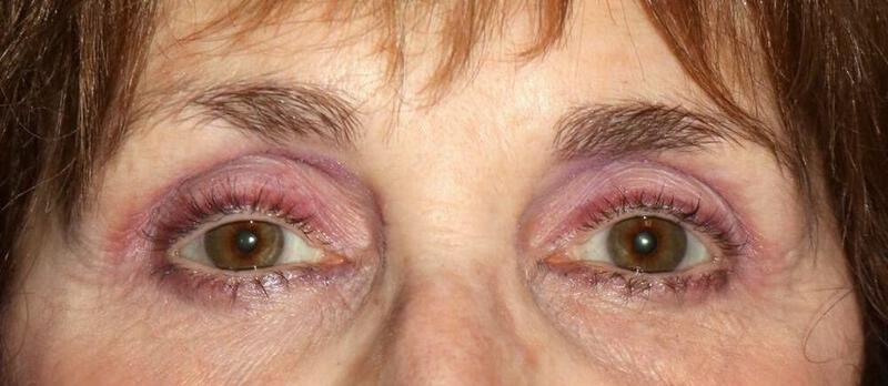 Blepharoplasty result at ARC Plastic Surgery